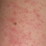 71 273 38871 1200444899 1 0103 DERMATITIS