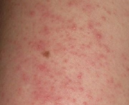 71 273 38871 1200444899 1 0103 DERMATITIS
