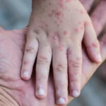 Manos viruela del mono
