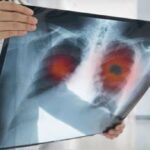 71 273 39977 2008731085 1 0404 CA PULMON