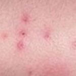 71 273 41074 1255888253 1 SESA 1906 VIRUELA SIMICA