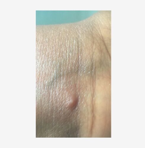 71 273 41504 1127014066 1 SESA 0724 VIRUELA SIMICA