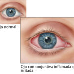 71 273 44023 1240418290 2 2803 SESA CONJUUNTIVITIS