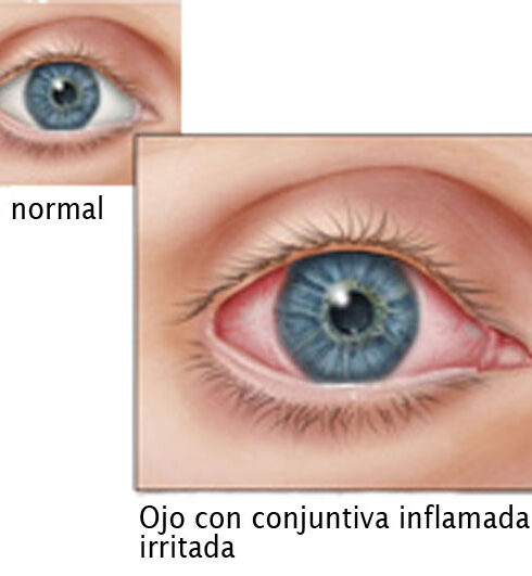 71 273 44023 1240418290 2 2803 SESA CONJUUNTIVITIS