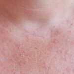 There are a lot of red pimples on a woman's chest. Allergy to the sun