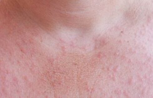 There are a lot of red pimples on a woman's chest. Allergy to the sun