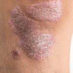 71 273 49610 885786940 1 2910 sesa psoriasis