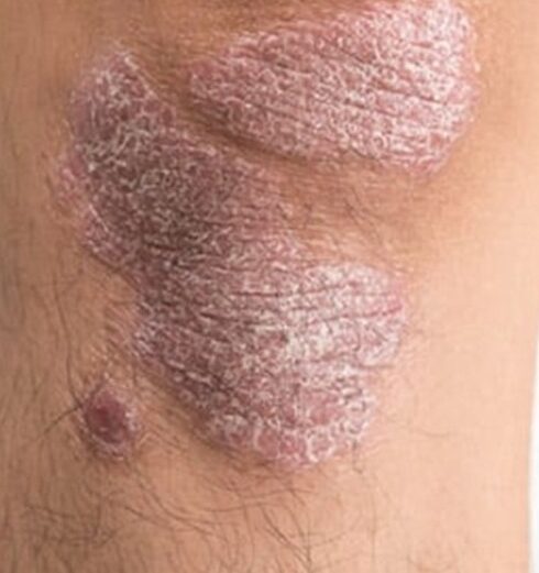 71 273 49610 885786940 1 2910 sesa psoriasis