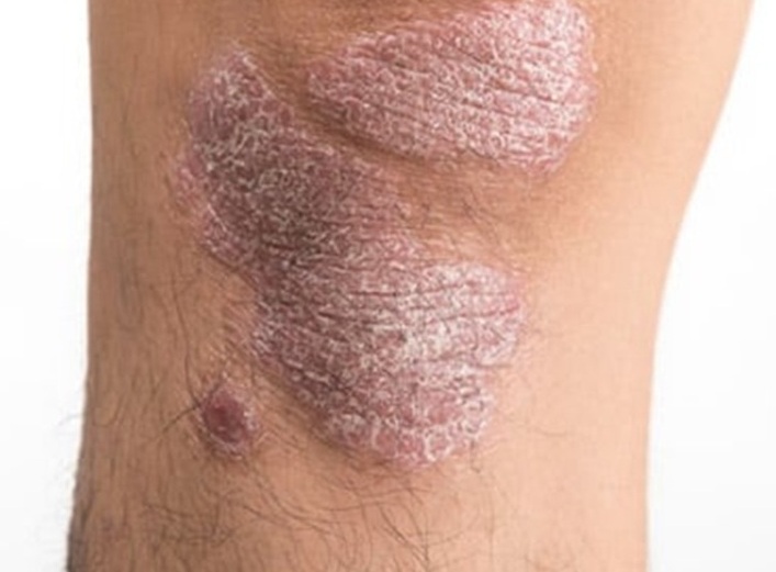 71 273 49610 885786940 1 2910 sesa psoriasis